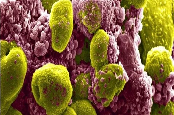پیشرفت چشمگیر در درمان سرطان پروستات تهاجمی با ترکیبی دارویی نوین